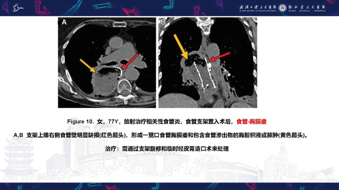 影像PPT - 【PPT】胸膜瘘影像诊断-23