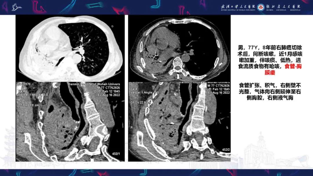影像PPT - 【PPT】胸膜瘘影像诊断-24