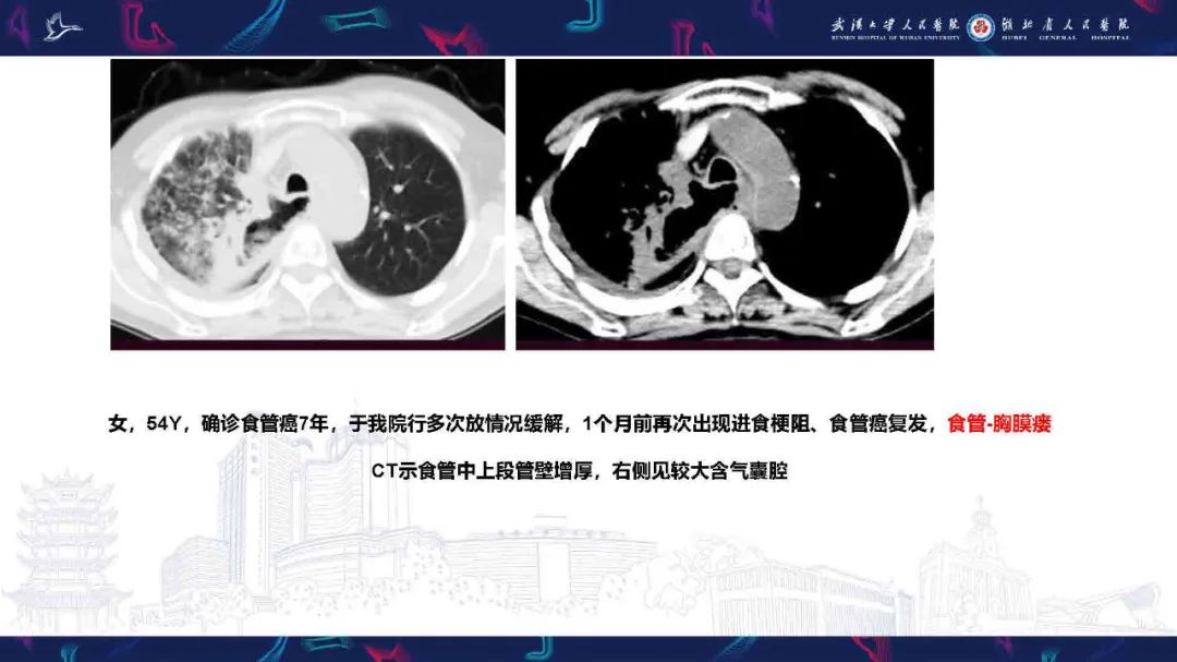 影像PPT - 【PPT】胸膜瘘影像诊断-25