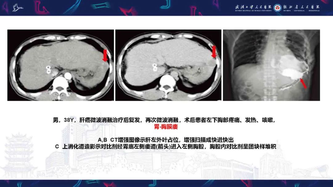 影像PPT - 【PPT】胸膜瘘影像诊断-29