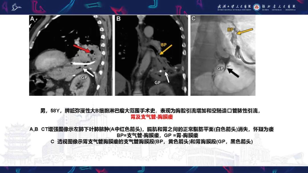影像PPT - 【PPT】胸膜瘘影像诊断-28