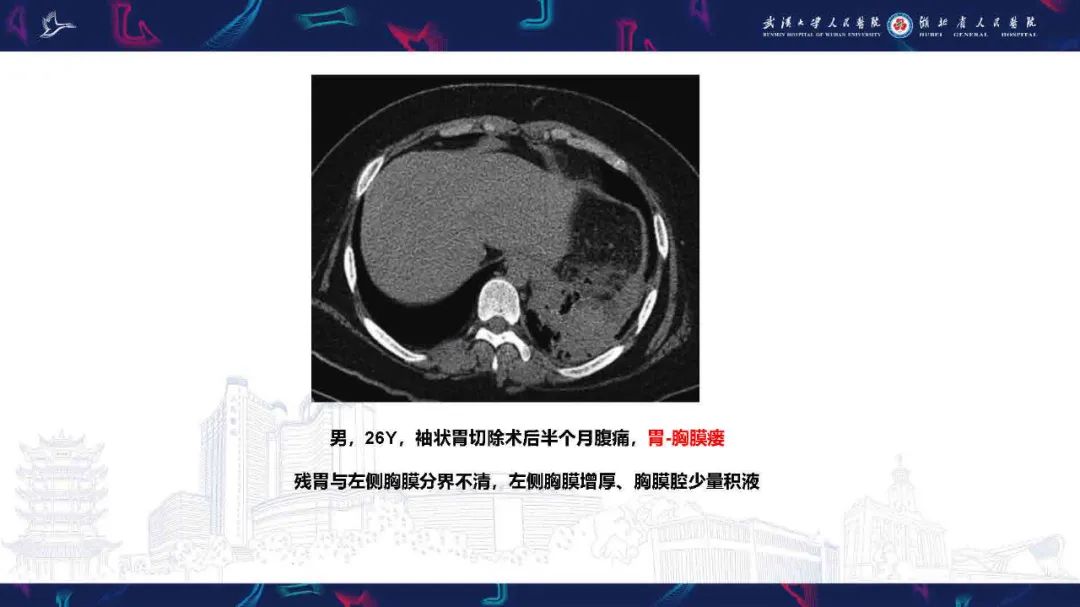 影像PPT - 【PPT】胸膜瘘影像诊断-30