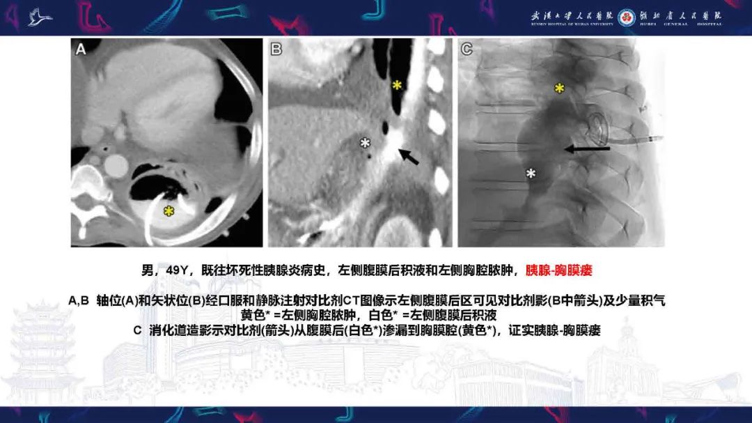 影像PPT - 【PPT】胸膜瘘影像诊断-33