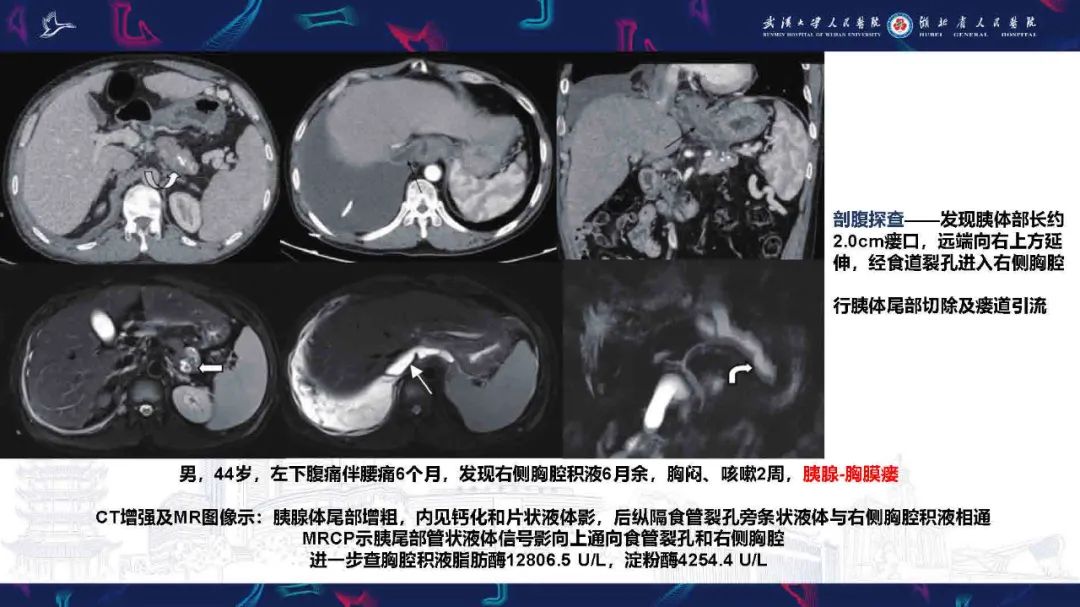 影像PPT - 【PPT】胸膜瘘影像诊断-35