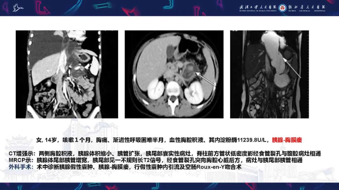 影像PPT - 【PPT】胸膜瘘影像诊断-34