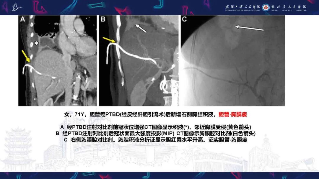 影像PPT - 【PPT】胸膜瘘影像诊断-37