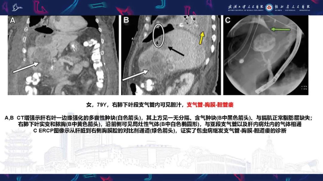 影像PPT - 【PPT】胸膜瘘影像诊断-39