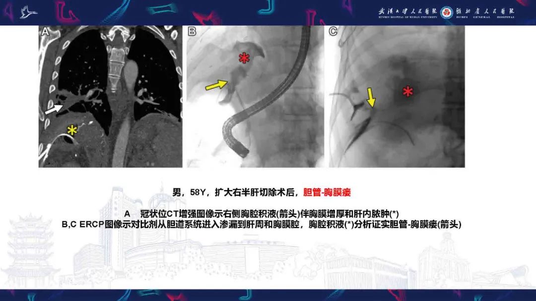 影像PPT - 【PPT】胸膜瘘影像诊断-38