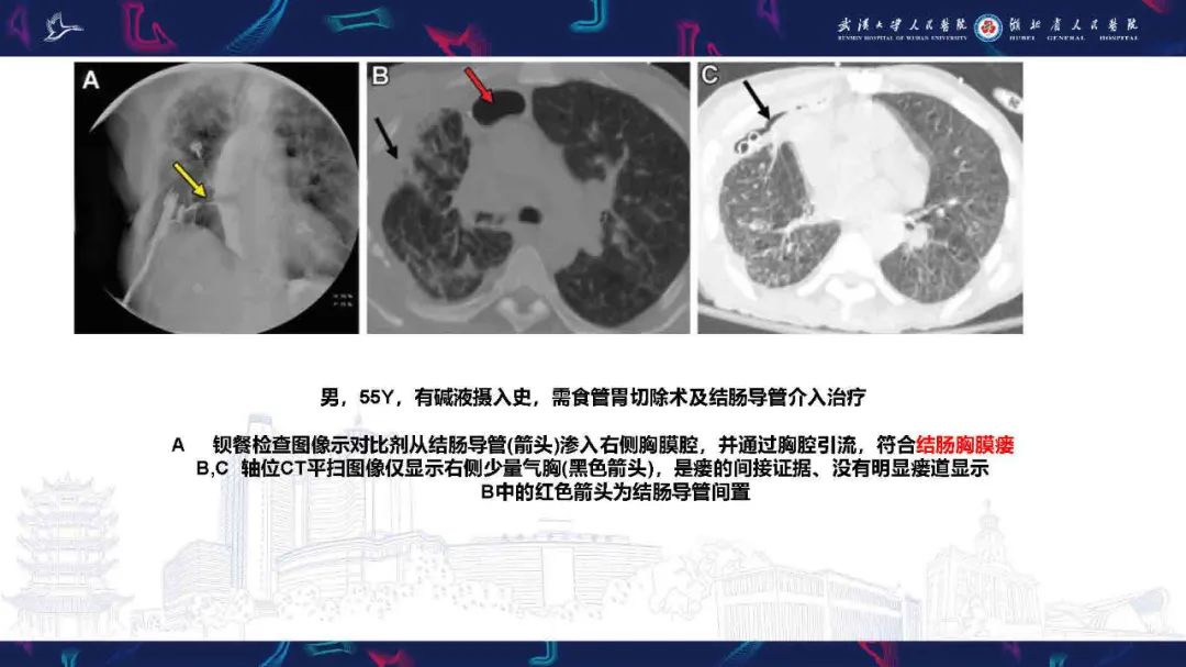 影像PPT - 【PPT】胸膜瘘影像诊断-41