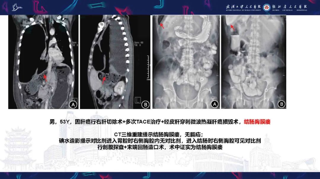 影像PPT - 【PPT】胸膜瘘影像诊断-42