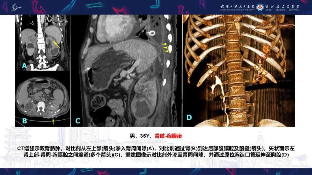 影像PPT - 【PPT】胸膜瘘影像诊断-45
