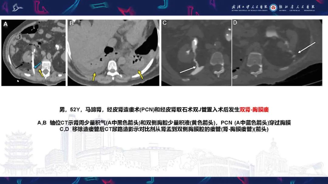 影像PPT - 【PPT】胸膜瘘影像诊断-44