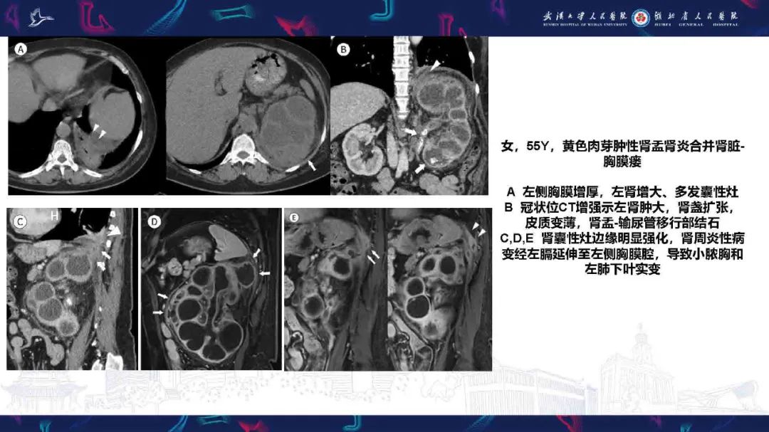 影像PPT - 【PPT】胸膜瘘影像诊断-46