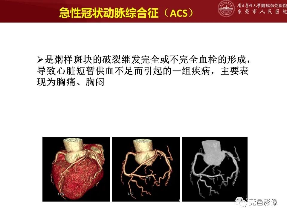 影像PPT - 【PPT】胸痛三联征CT扫描技术-4