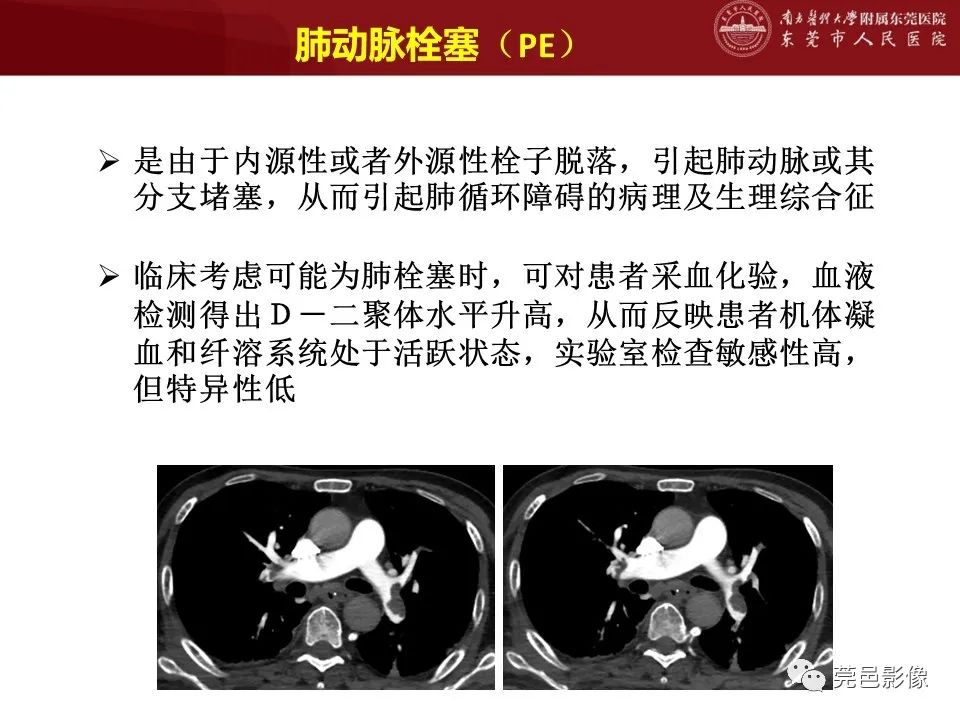 影像PPT - 【PPT】胸痛三联征CT扫描技术-5