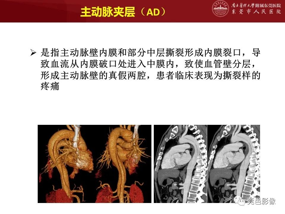 影像PPT - 【PPT】胸痛三联征CT扫描技术-6