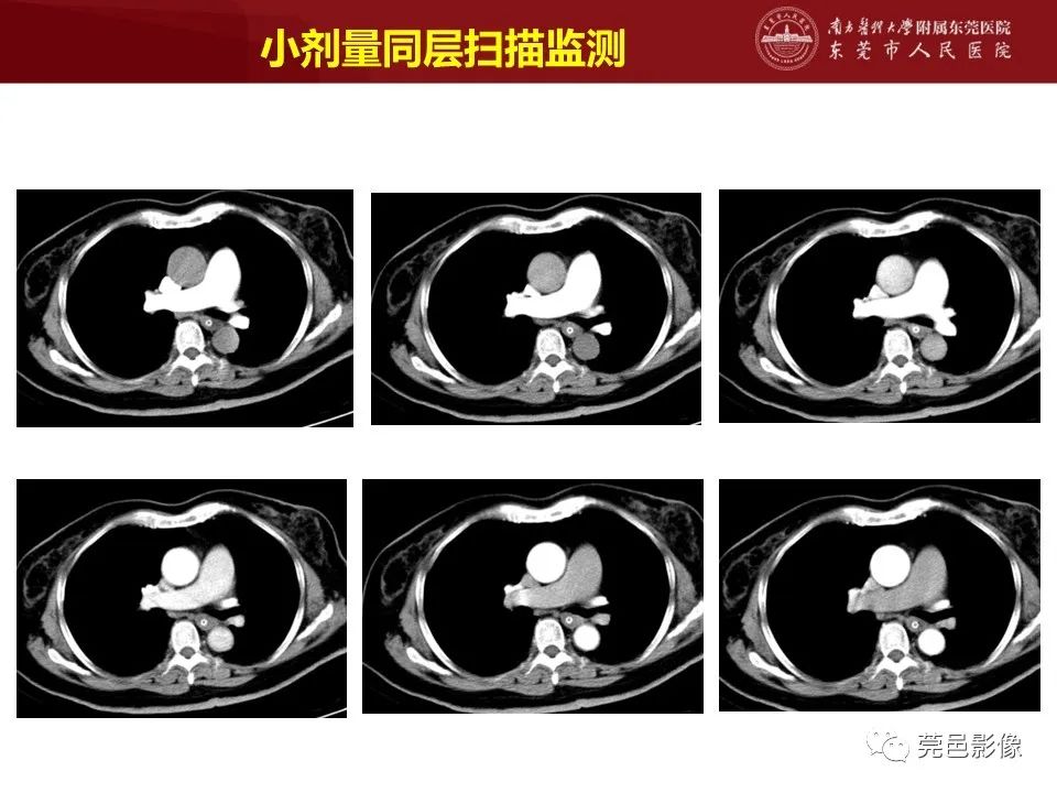 影像PPT - 【PPT】胸痛三联征CT扫描技术-24