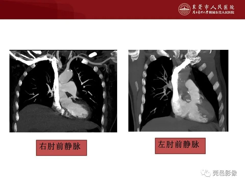 影像PPT - 【PPT】胸痛三联征CT扫描技术-30