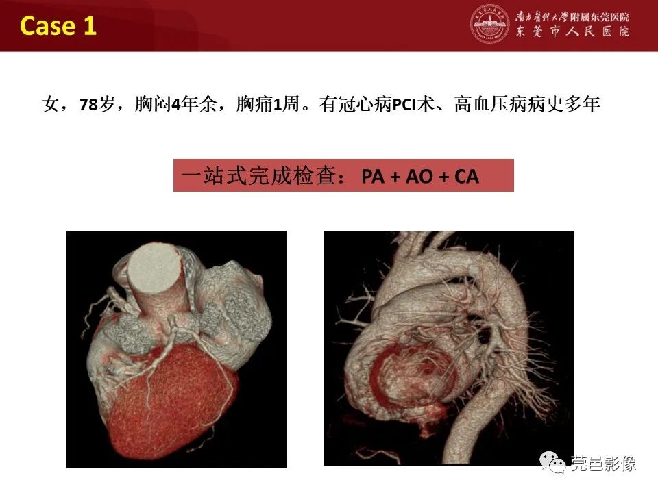 影像PPT - 【PPT】胸痛三联征CT扫描技术-35