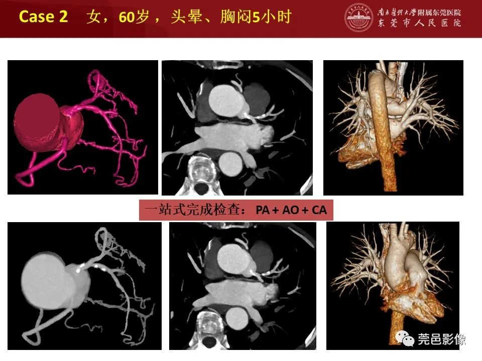 影像PPT - 【PPT】胸痛三联征CT扫描技术-39