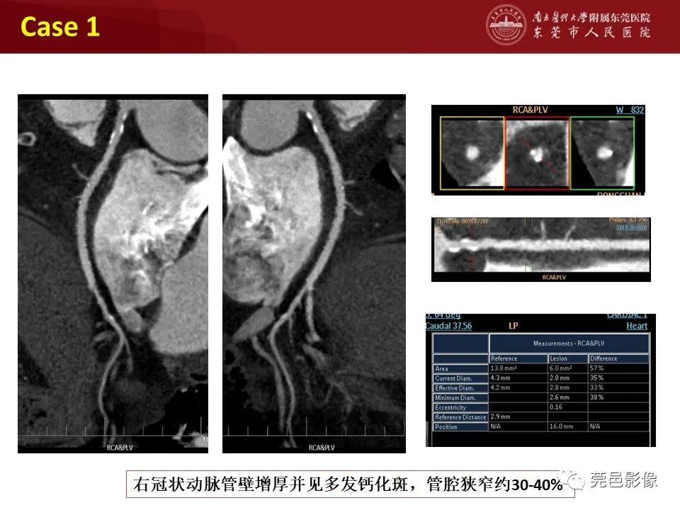 影像PPT - 【PPT】胸痛三联征CT扫描技术-38