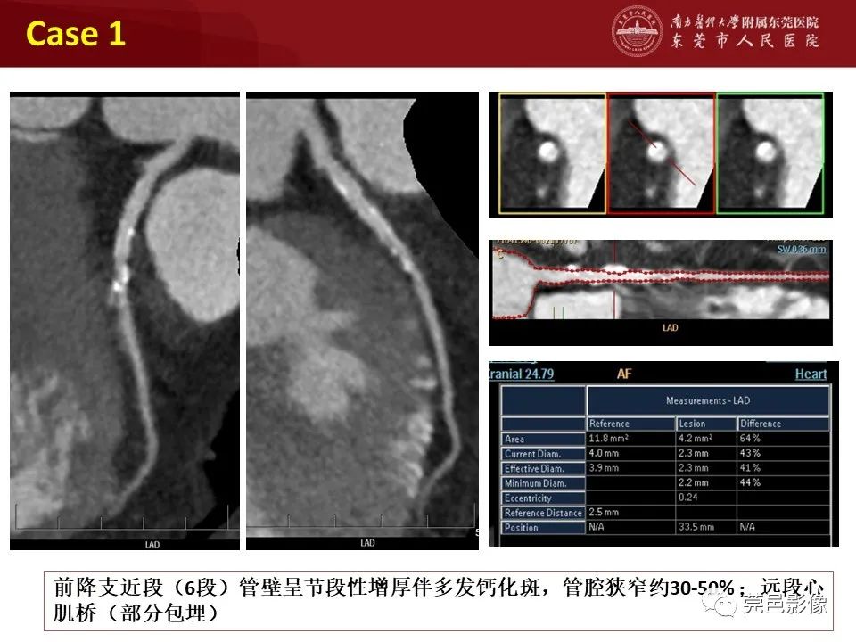影像PPT - 【PPT】胸痛三联征CT扫描技术-37