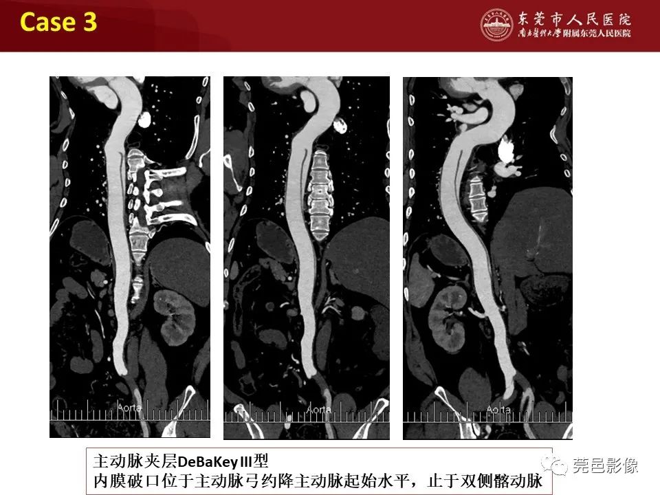 影像PPT - 【PPT】胸痛三联征CT扫描技术-41