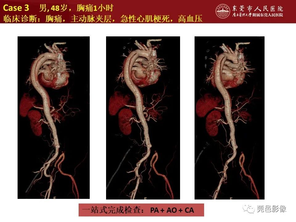 影像PPT - 【PPT】胸痛三联征CT扫描技术-40