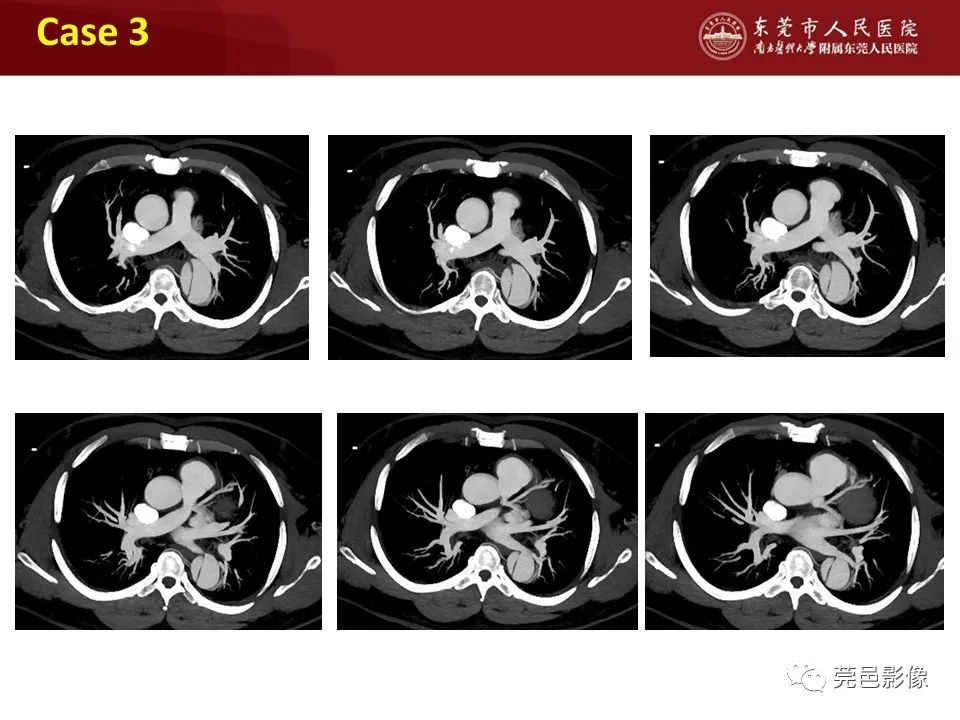 影像PPT - 【PPT】胸痛三联征CT扫描技术-42