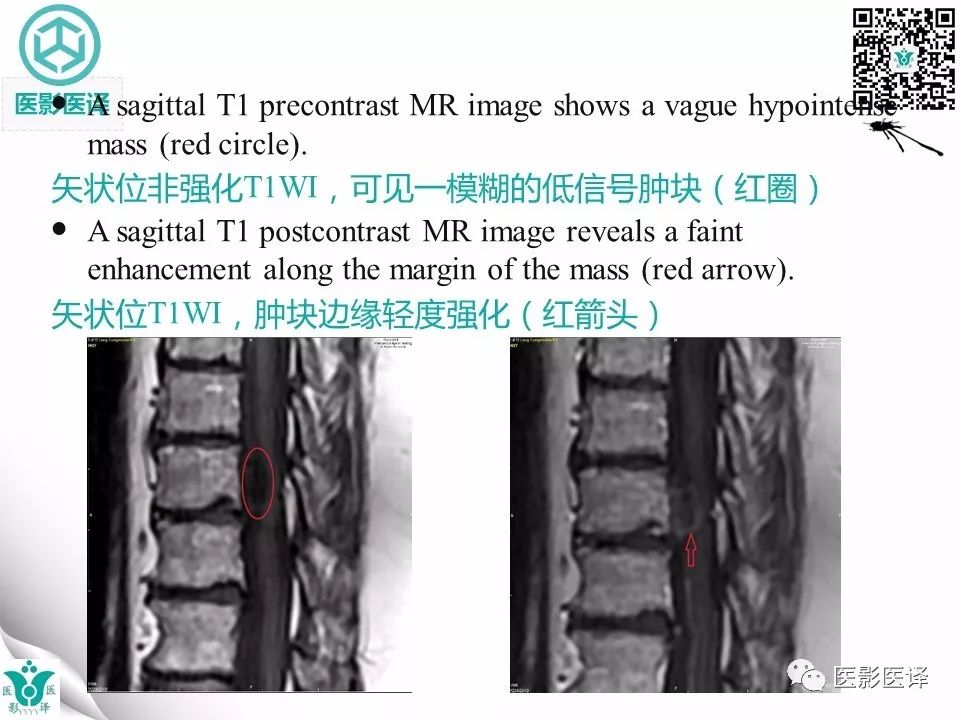 影像PPT - 【病例】神经中轴钙化性假瘤1例-12