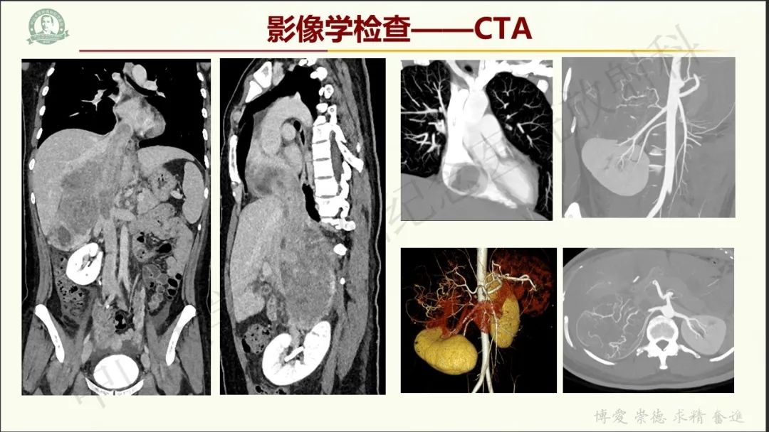 影像PPT - 【病例】肾上腺皮质腺癌1例CT及MR影像-5
