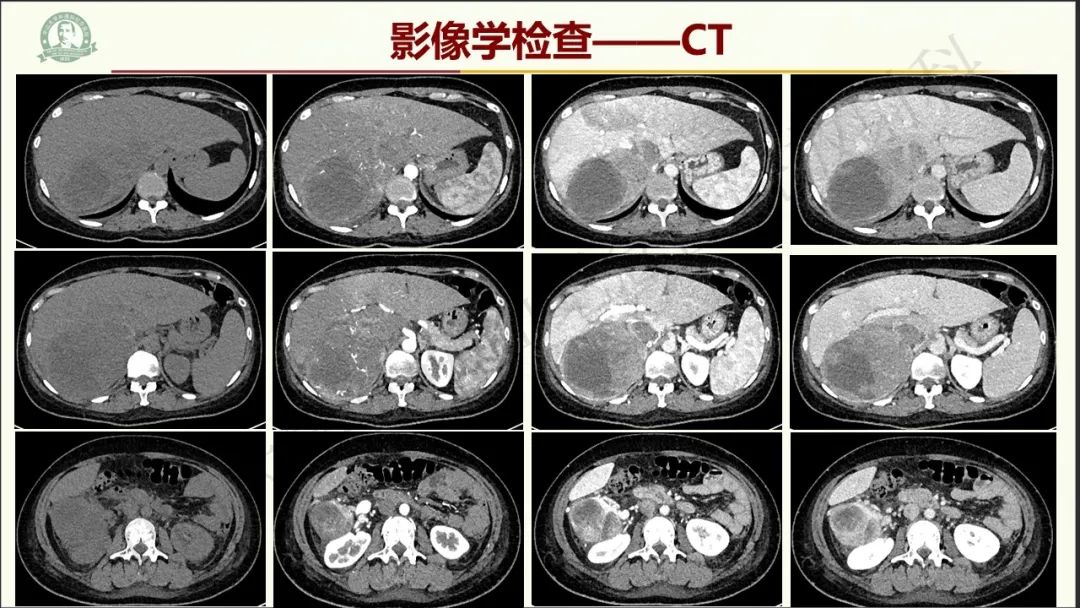 影像PPT - 【病例】肾上腺皮质腺癌1例CT及MR影像-4