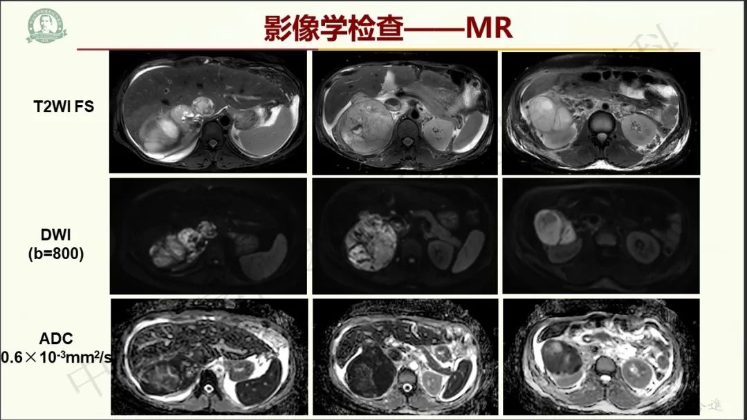 影像PPT - 【病例】肾上腺皮质腺癌1例CT及MR影像-7