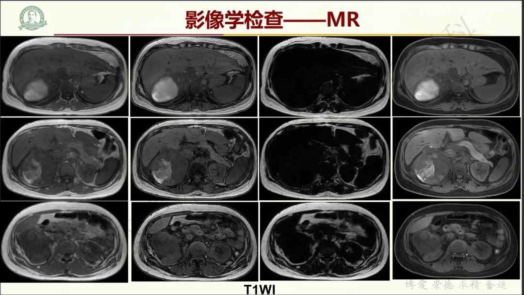 影像PPT - 【病例】肾上腺皮质腺癌1例CT及MR影像-6