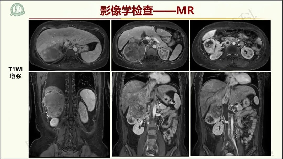 影像PPT - 【病例】肾上腺皮质腺癌1例CT及MR影像-8