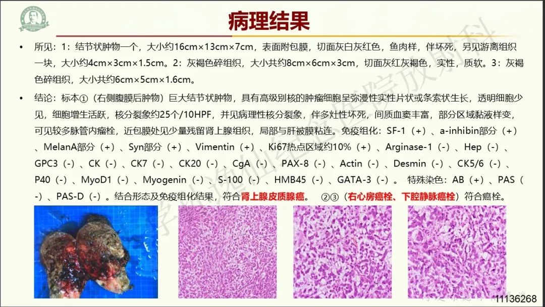 影像PPT - 【病例】肾上腺皮质腺癌1例CT及MR影像-11