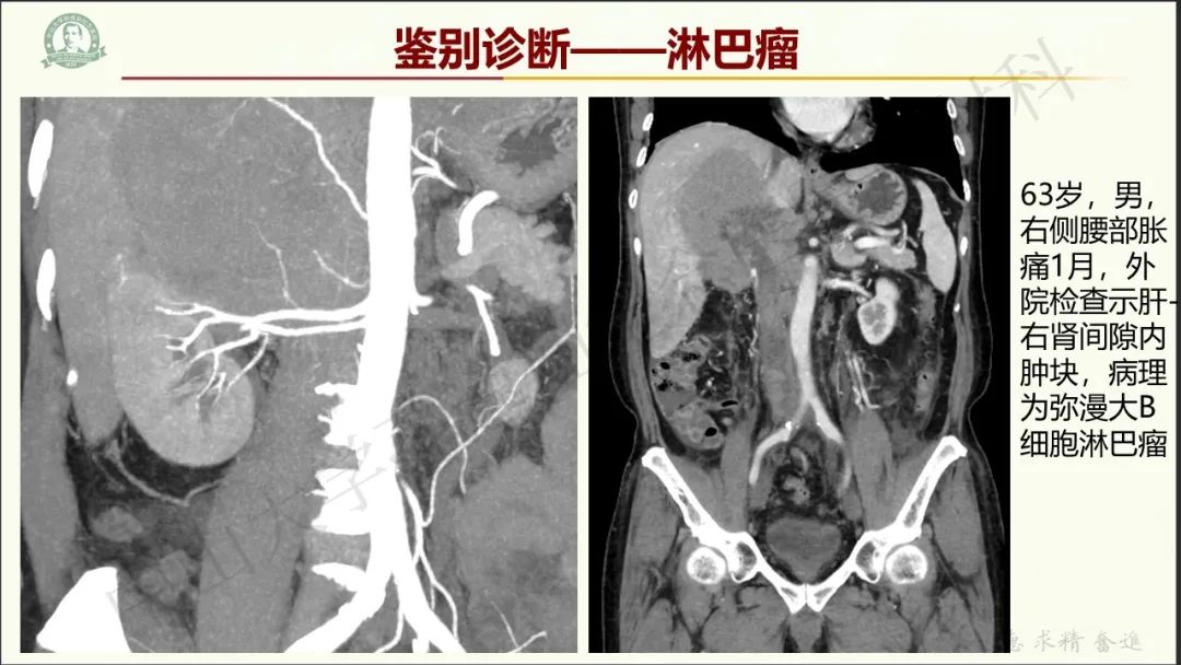影像PPT - 【病例】肾上腺皮质腺癌1例CT及MR影像-16