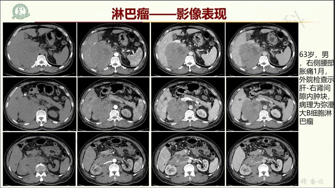 影像PPT - 【病例】肾上腺皮质腺癌1例CT及MR影像-15