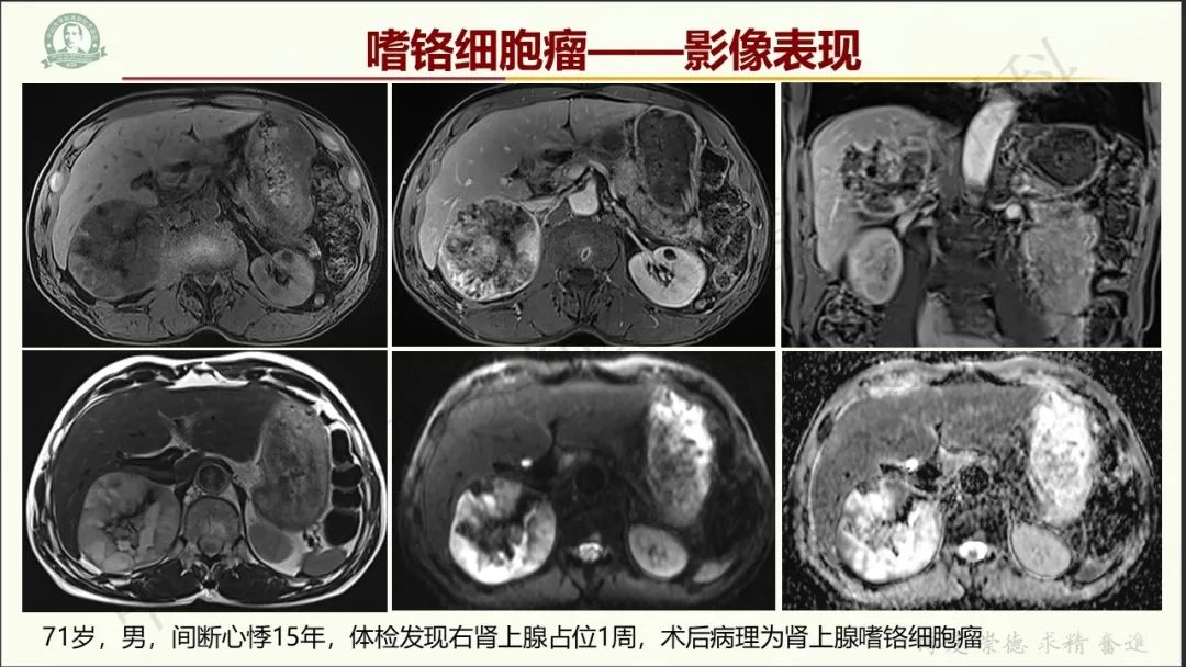 影像PPT - 【病例】肾上腺皮质腺癌1例CT及MR影像-19