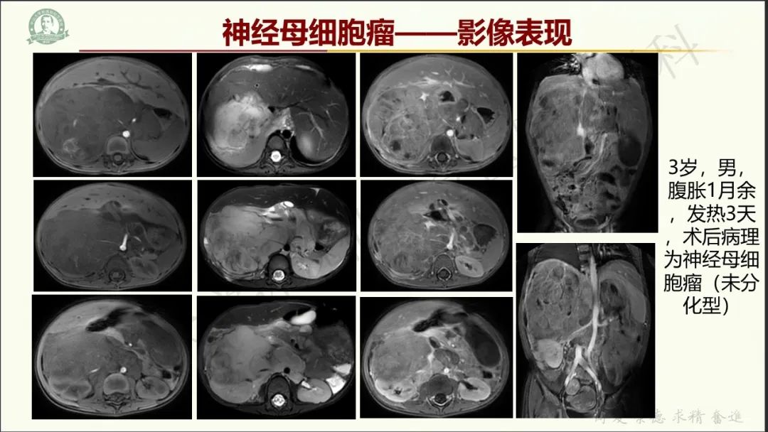 影像PPT - 【病例】肾上腺皮质腺癌1例CT及MR影像-21