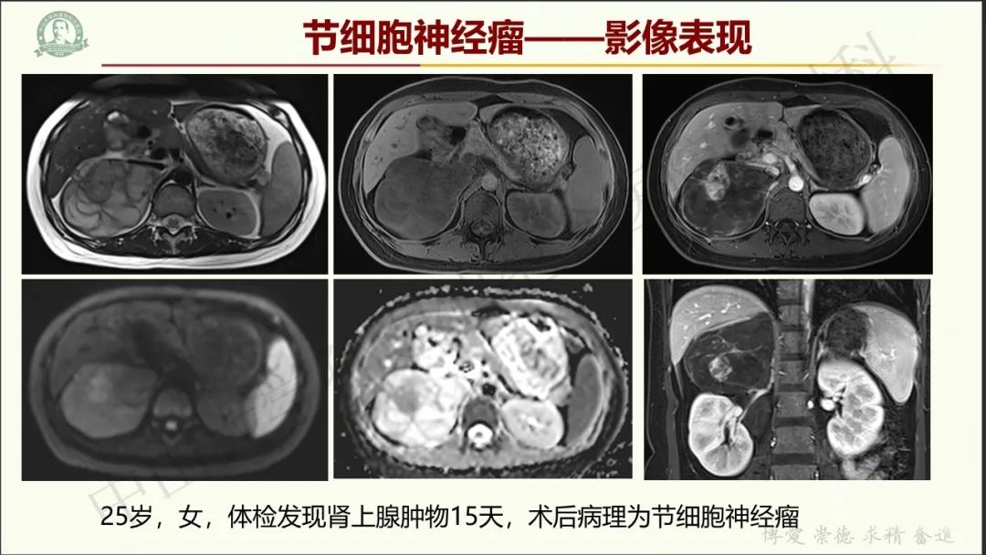 影像PPT - 【病例】肾上腺皮质腺癌1例CT及MR影像-23