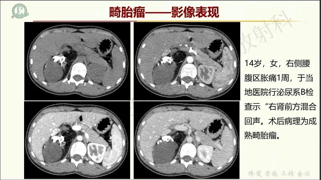 影像PPT - 【病例】肾上腺皮质腺癌1例CT及MR影像-27