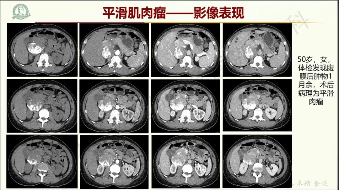影像PPT - 【病例】肾上腺皮质腺癌1例CT及MR影像-29