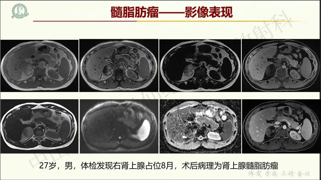 影像PPT - 【病例】肾上腺皮质腺癌1例CT及MR影像-25