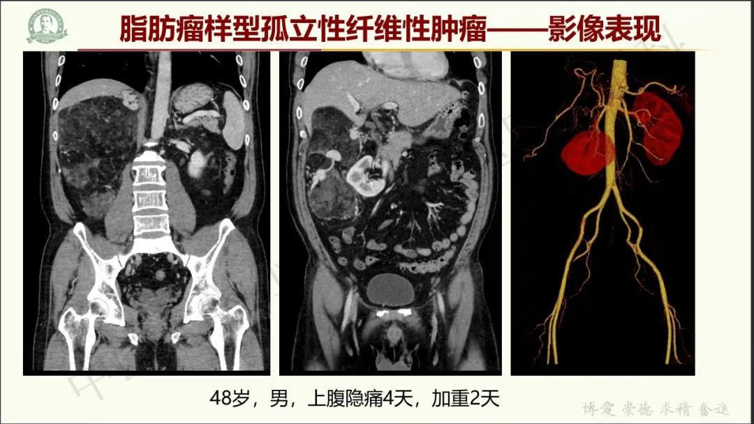 影像PPT - 【病例】肾上腺皮质腺癌1例CT及MR影像-32