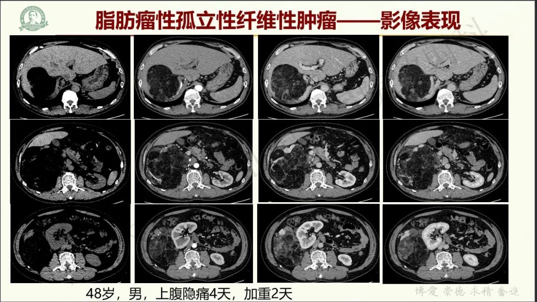 影像PPT - 【病例】肾上腺皮质腺癌1例CT及MR影像-31