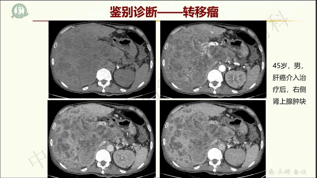 影像PPT - 【病例】肾上腺皮质腺癌1例CT及MR影像-34