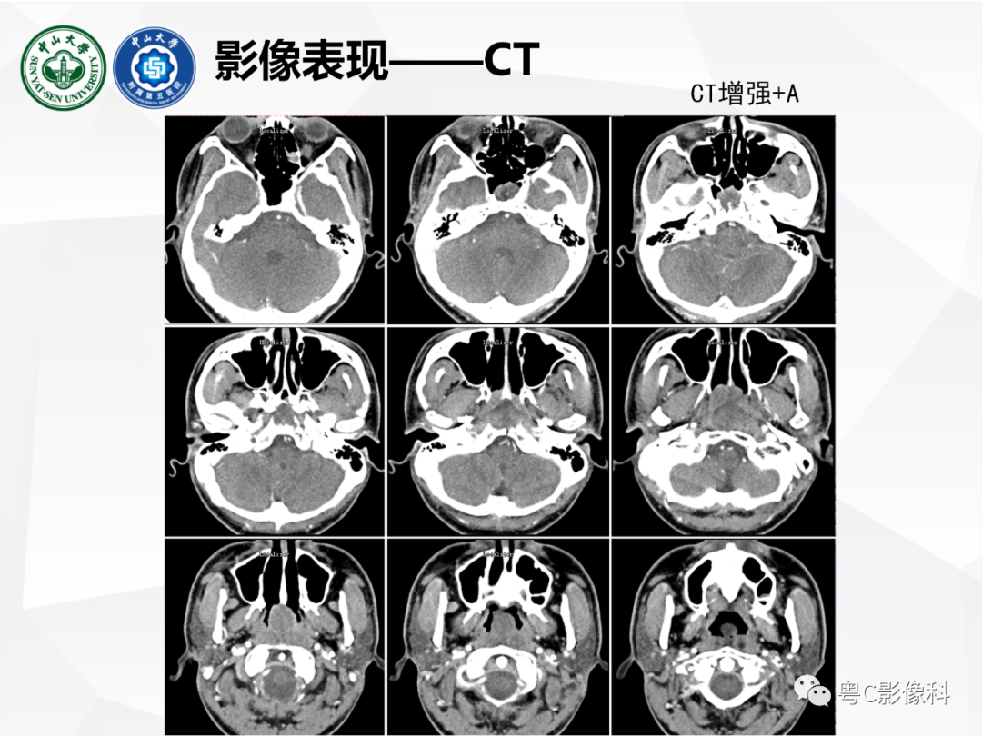 影像PPT - 【病例】颅底脊索瘤1例CT及MR影像表现及鉴别诊断-5