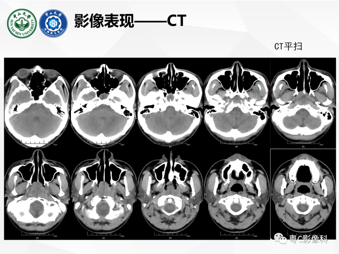 影像PPT - 【病例】颅底脊索瘤1例CT及MR影像表现及鉴别诊断-4