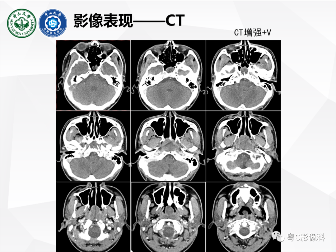 影像PPT - 【病例】颅底脊索瘤1例CT及MR影像表现及鉴别诊断-6